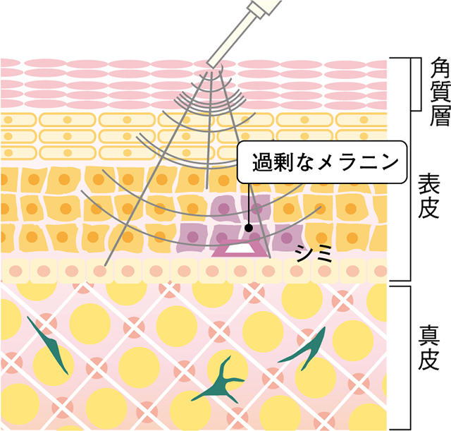 マイナス（－）の力と超音波（マイクロキャビの力）で美容成分を浸透、拡散！