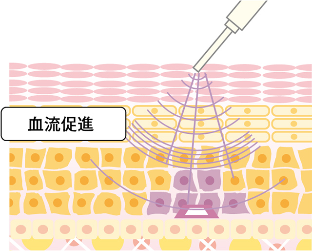 マイクロキャビの振動と（＋）（－）の間欠導入で美容成分を拡散、浸透！