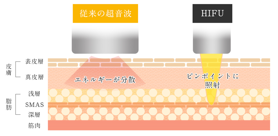 HIFUの仕組み