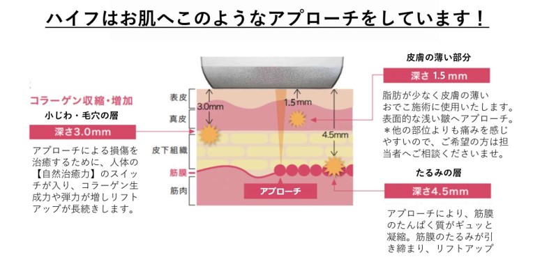 ハイフはお肌へこのようなアプローチをしています！